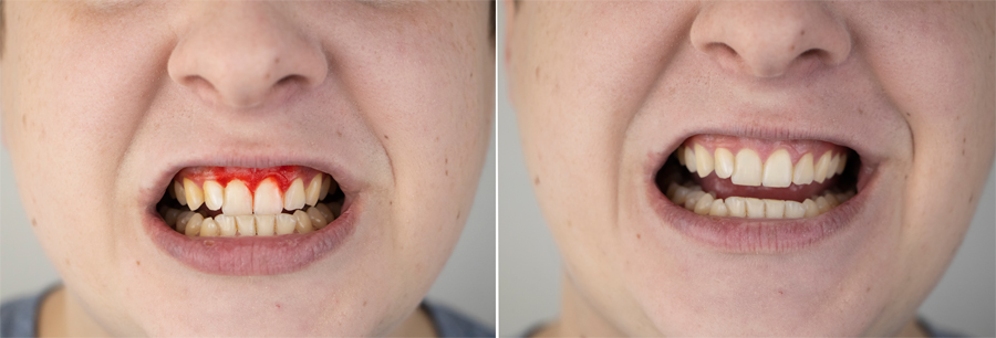 профилактика и лечение любых заболеваний пародонта – десен и костной ткани, окружающей зубы в Щербинке